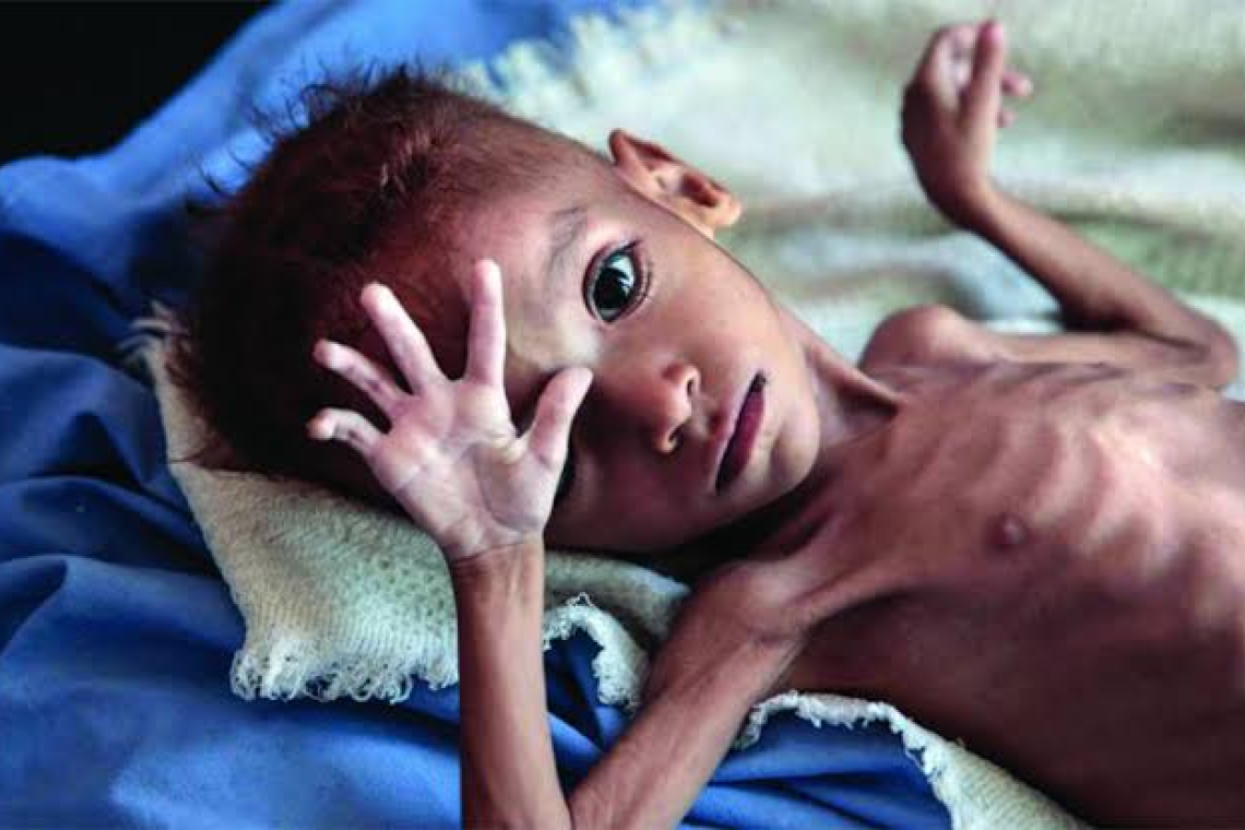 උග්‍ර මන්ද පෝෂණයෙන් පෙළෙන දරුවෝ 10,000 ක් – දරුවන් 188,714 කට වයසට ගැළපෙන බර නෑ